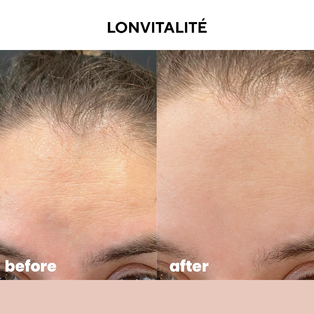 Lonvitalite 24K Gold & Collagen Eye Masks & Derma Roller Bundle